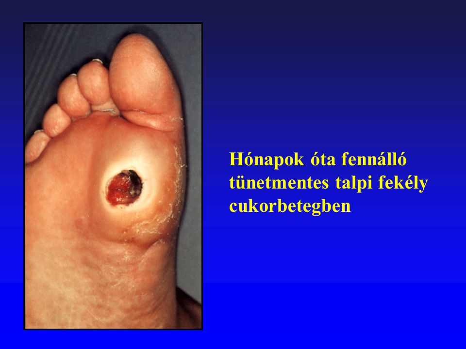 Cukorbetegség az ujjak lábujjainak torna