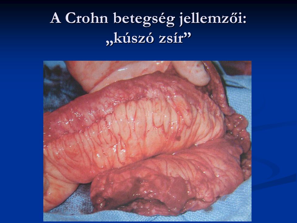 crohn- betegség és prostatitis