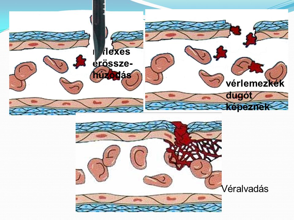 reflexes érössze- húzódás vérlemezkék dugót képeznek Véralvadás