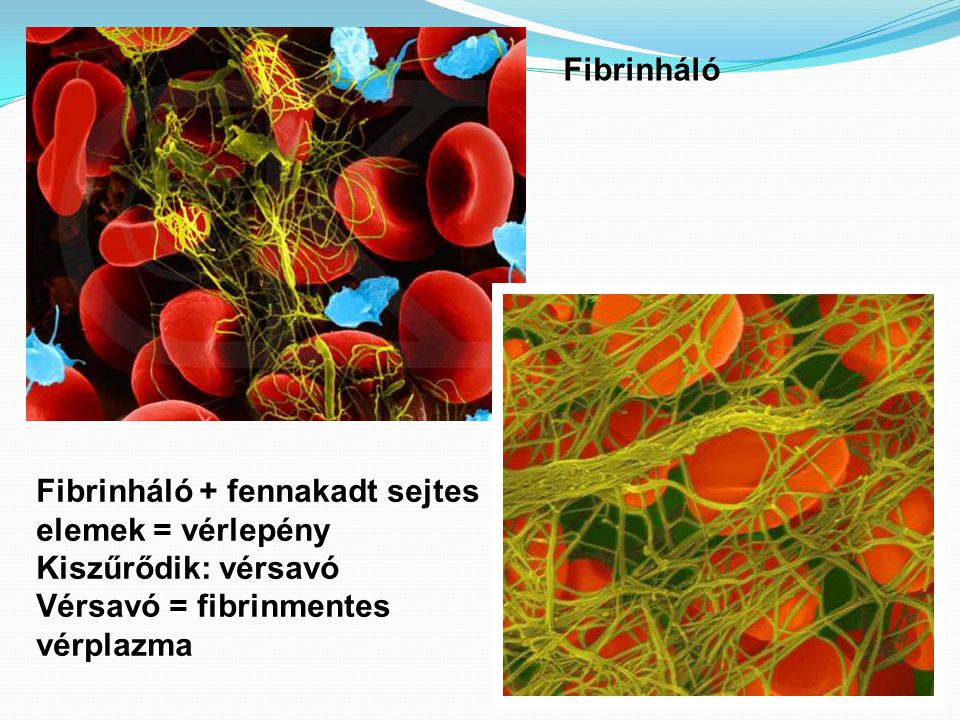 Fibrinháló Fibrinháló + fennakadt sejtes. elemek = vérlepény. Kiszűrődik: vérsavó. Vérsavó = fibrinmentes.