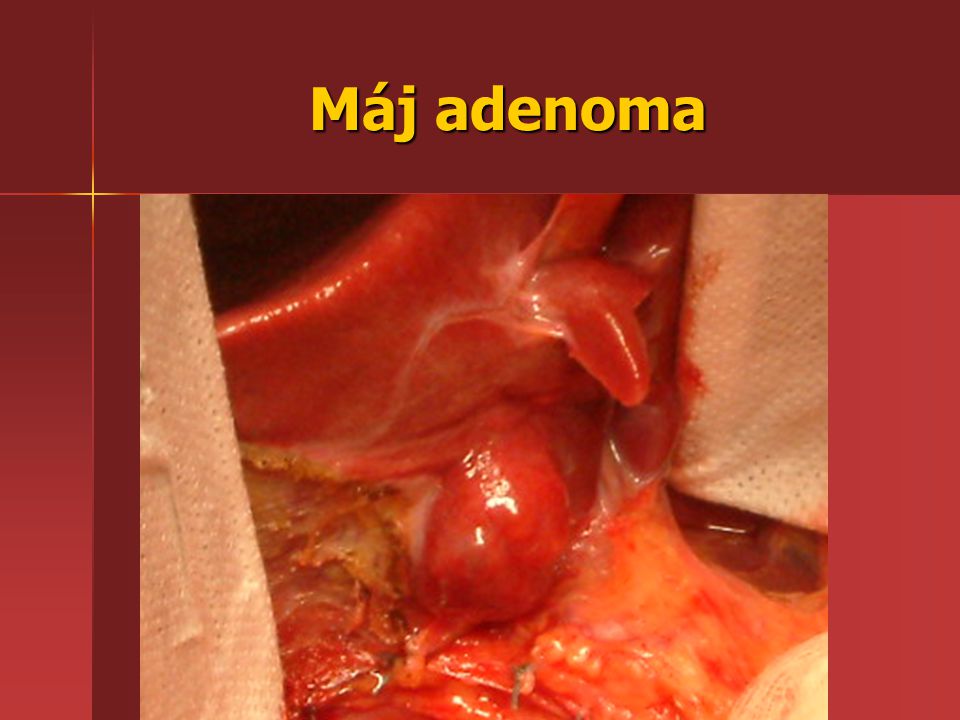 máj adenoma rosszindulatú prosztata daganat