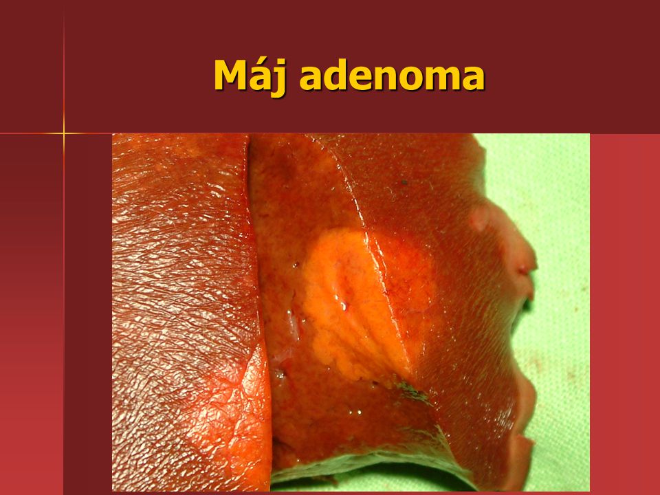máj adenoma gyógyítása