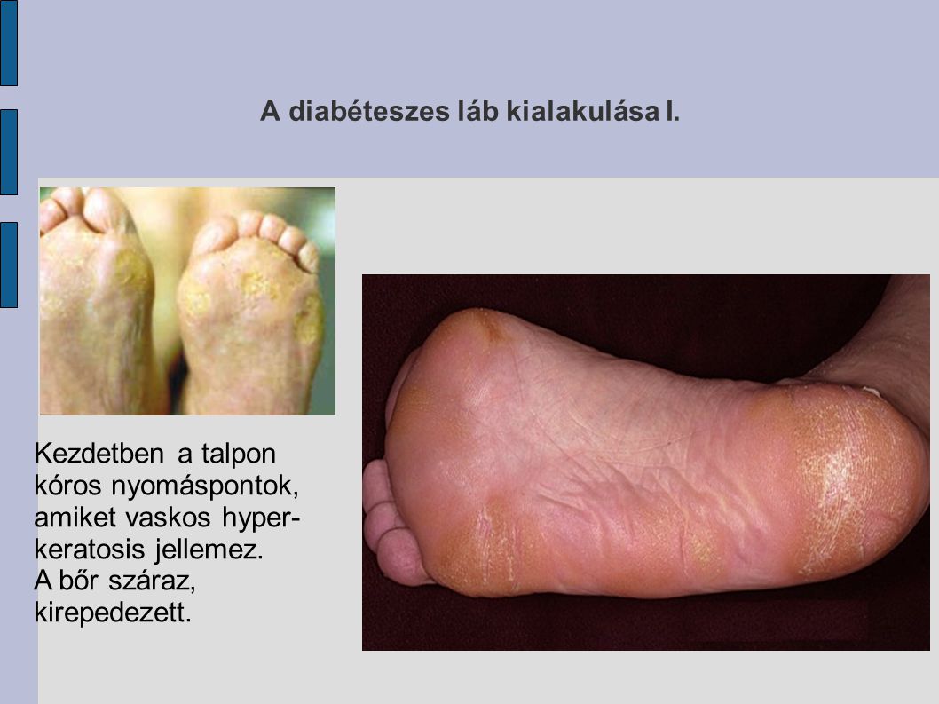 angiopathia lábak cukorbetegséggel)