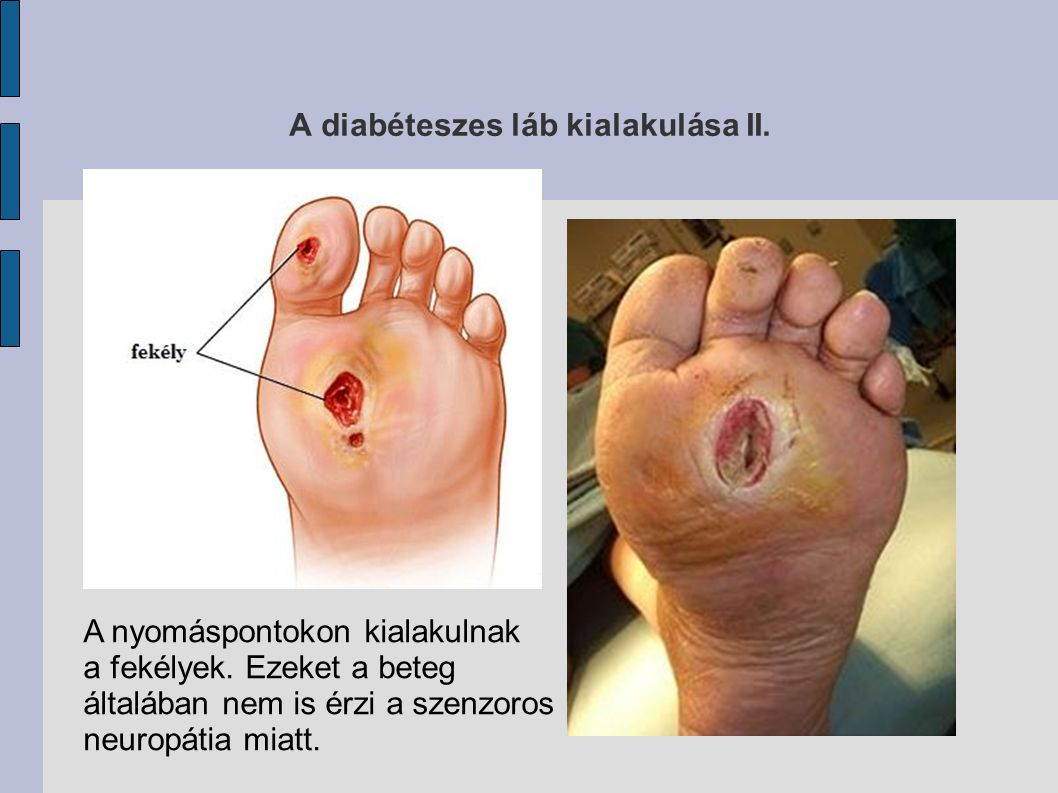 fekély láb diabétesz kezelésére)