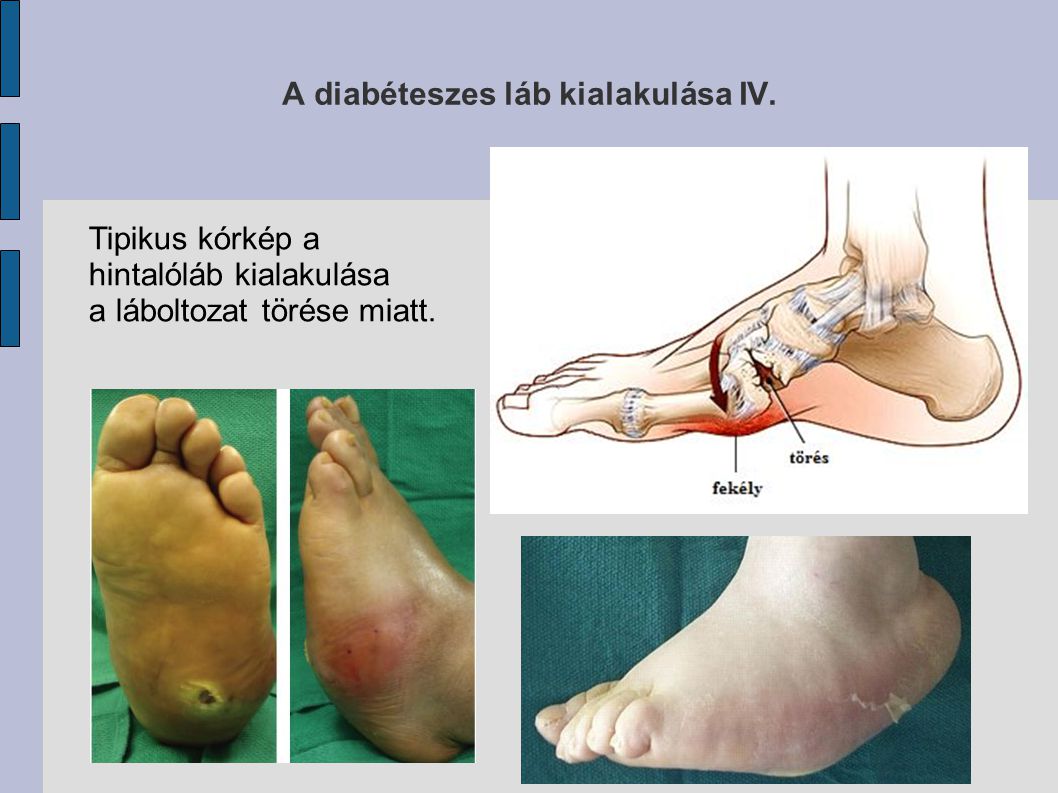 Diabéteszes angiopathia, a cukorbetegség szövődményei közül a legsúlyosabb eHealth Románia