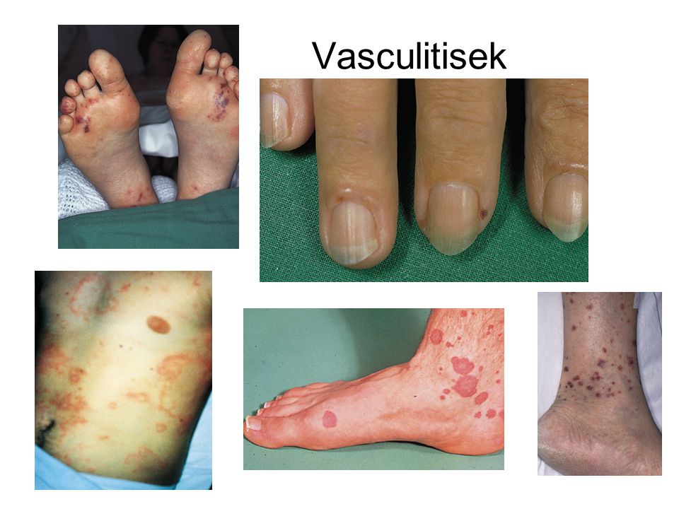 vasculitis közös kezelése