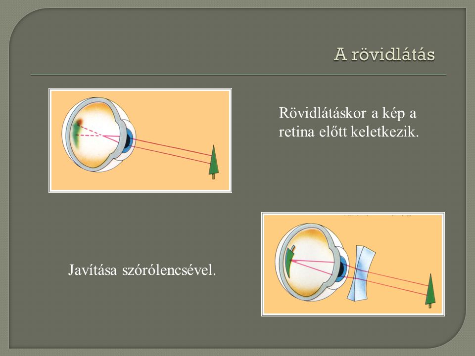 A rövidlátás Rövidlátáskor a kép a retina előtt keletkezik.