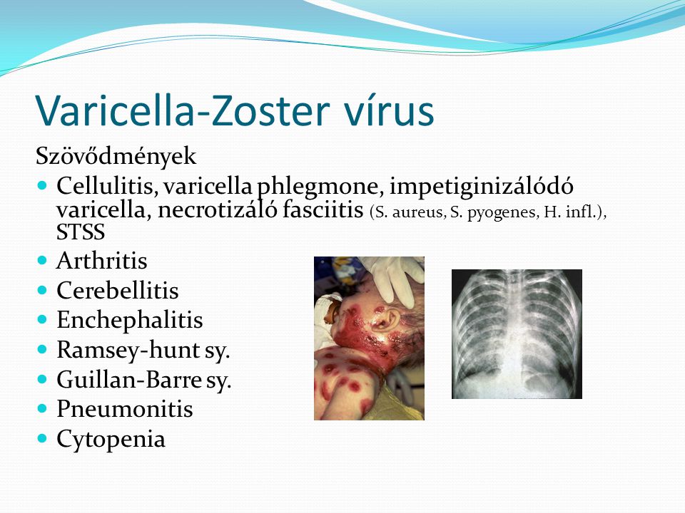 Varicella-Zoster vírus