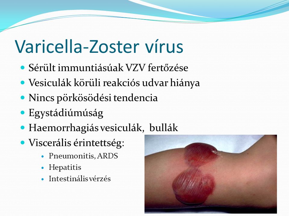 Varicella-Zoster vírus