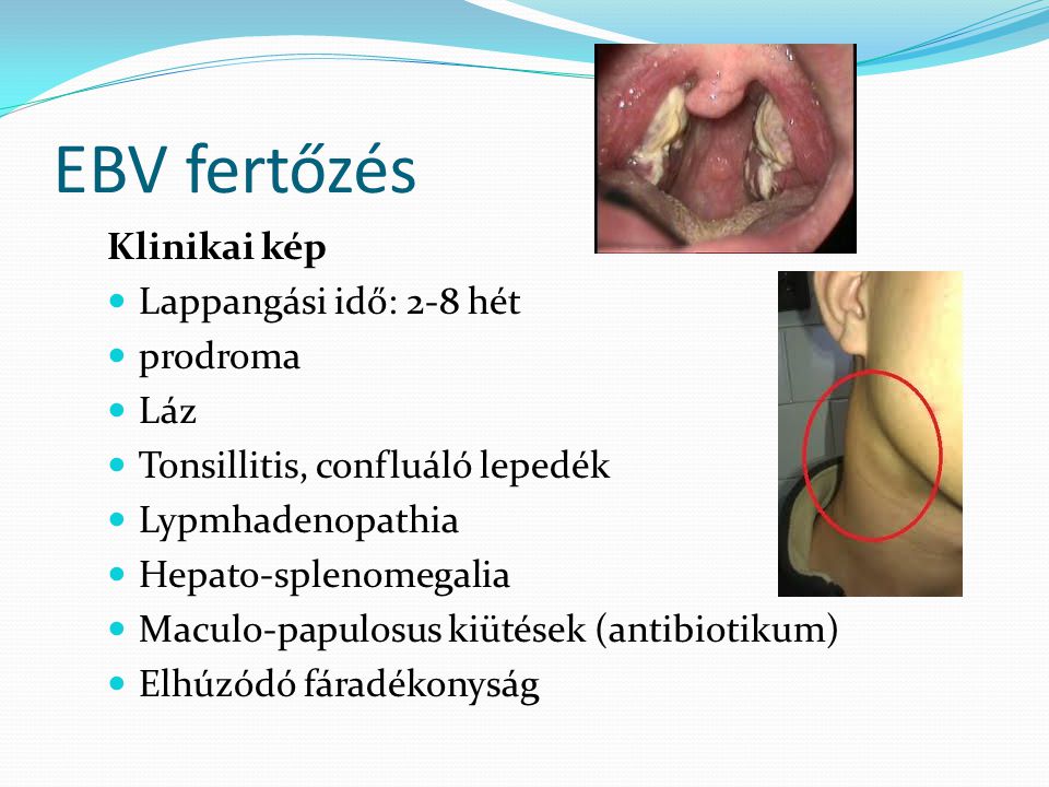 EBV fertőzés Klinikai kép Lappangási idő: 2-8 hét prodroma Láz
