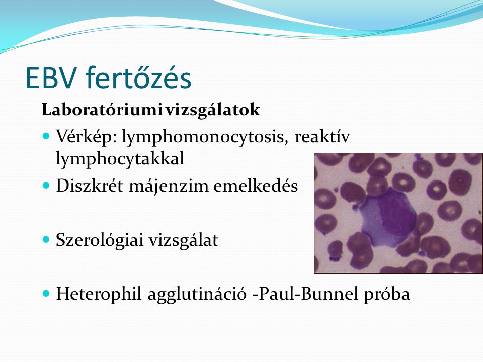 EBV fertőzés Vérkép: lymphomonocytosis, reaktív lymphocytakkal