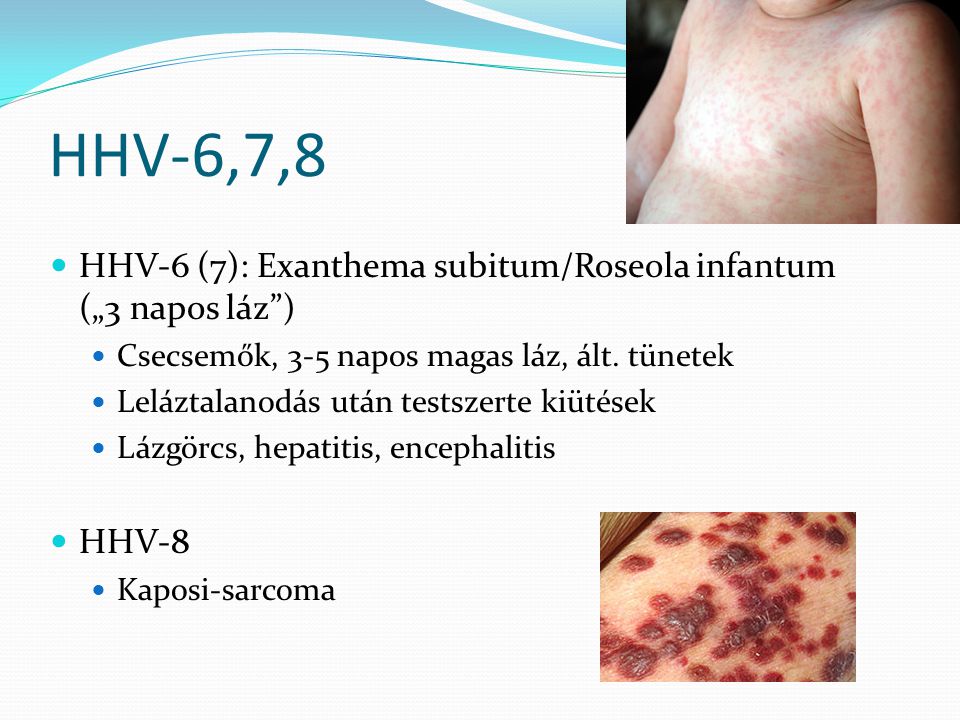 HHV-6,7,8 HHV-6 (7): Exanthema subitum/Roseola infantum („3 napos láz ) Csecsemők, 3-5 napos magas láz, ált. tünetek.