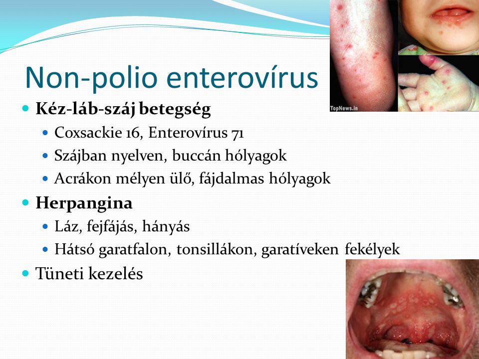 Non-polio enterovírus