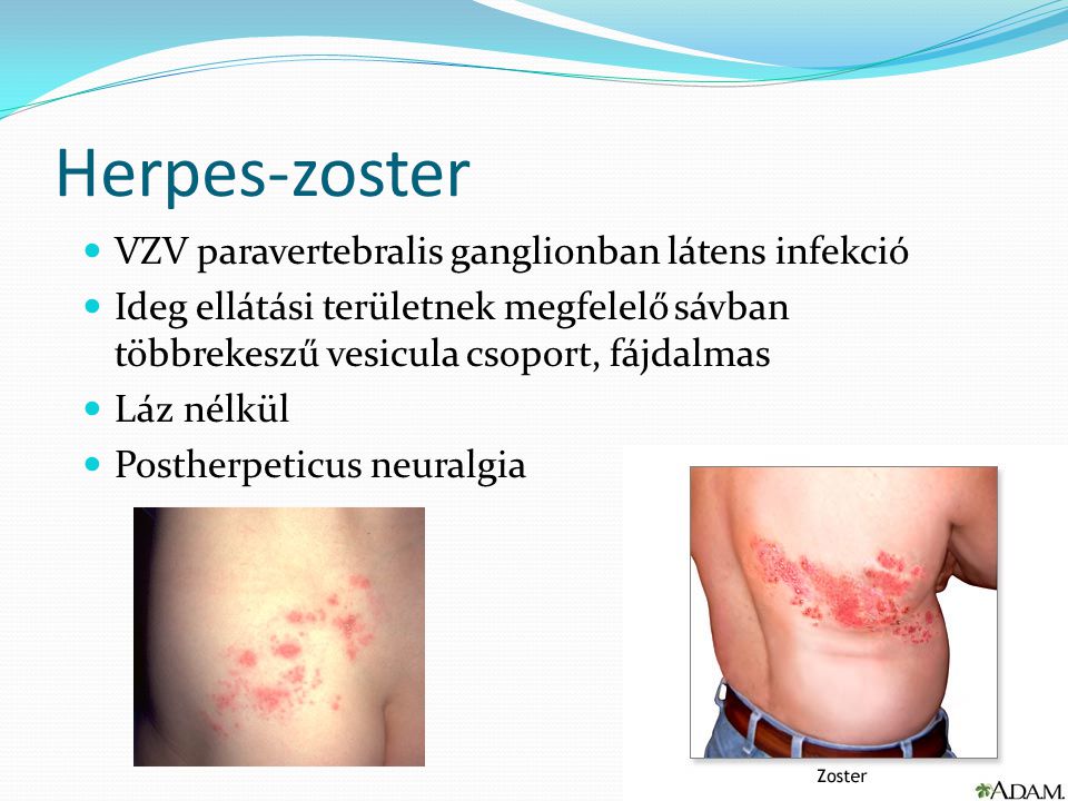 Herpes-zoster VZV paravertebralis ganglionban látens infekció